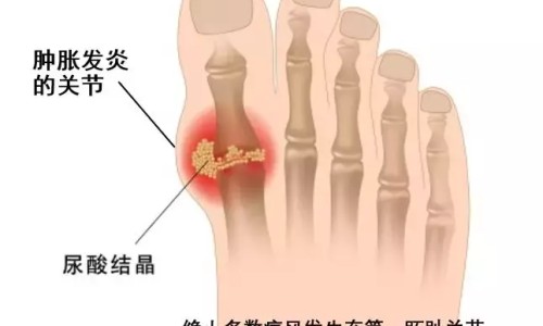帕金森病人肺部感染症状表现-帕金森病人肺部感染症状网-分享帕金森病人肺部感染症状有哪些，帕金森病人肺部感染症状有哪些知识库